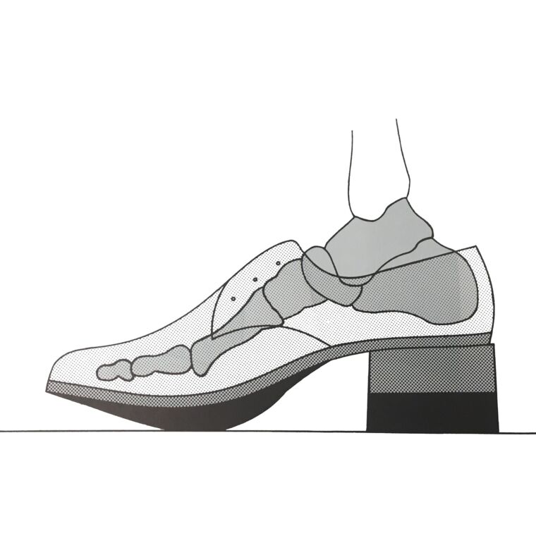 Einseitige Schuherhöhung / Verkürzungsausgleich